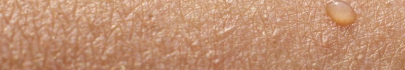¿Qué es la piel atópica?